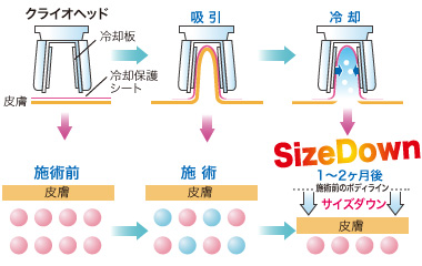 クライオリポライシスイラスト